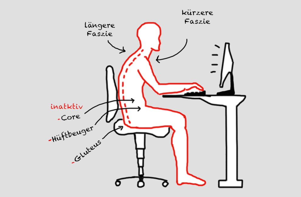 Beim Schreibtischtäter verlängert sich die dorsale (rückwärtige) Faszie, während sich die ventrale (bauchwärtige) Faszie verkürzt.